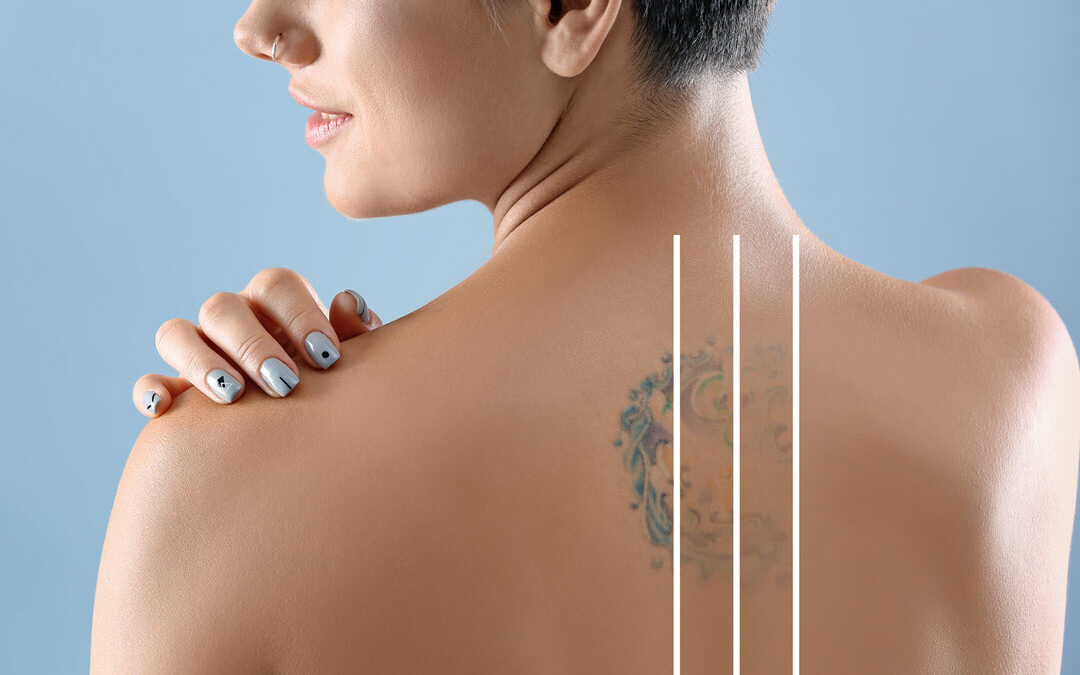 Exploring Tattoo Removal Options