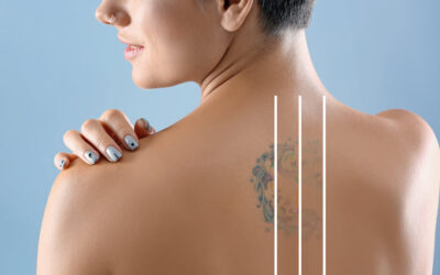 Exploring Tattoo Removal Options